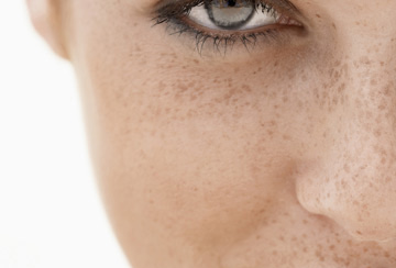 Dull skin cells